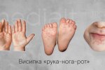На Київщині зафіксували спалах вірусу Коксакі серед дітей