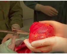 В Інституті серця видалили величезну кісту у понад 1 літр (відео)