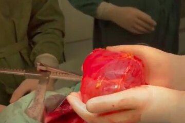 В Інституті серця видалили величезну кісту у понад 1 літр (відео)