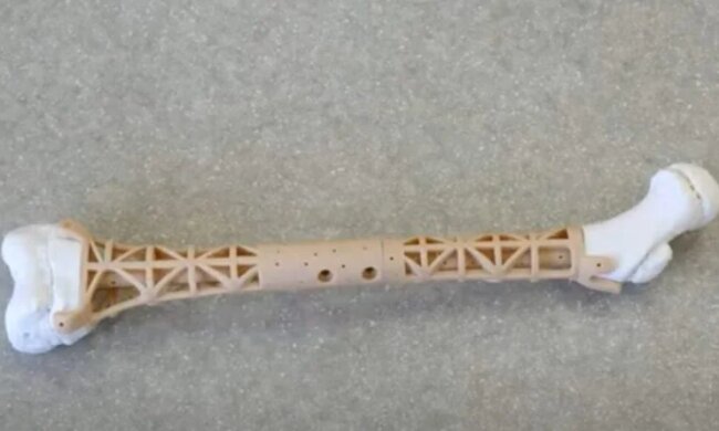 У КПІ розробили унікальний 3D-імплант, що росте разом із кістками та рятує життя