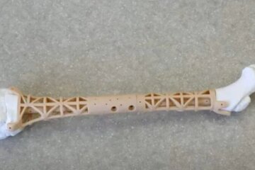 У КПІ розробили унікальний 3D-імплант, що росте разом із кістками та рятує життя