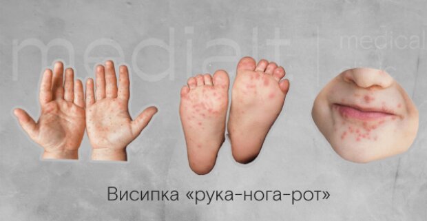 На Київщині зафіксували спалах вірусу Коксакі серед дітей