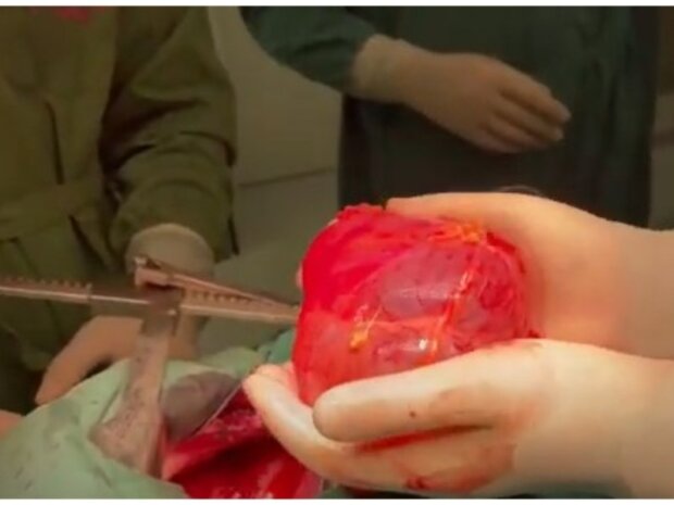 В Інституті серця видалили величезну кісту у понад 1 літр (відео)