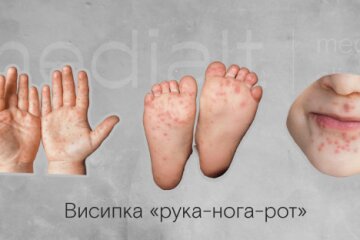 На Київщині зафіксували спалах вірусу Коксакі серед дітей