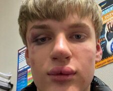 На Контрактовій площі побили 16-річного хлопця за нафарбовані губи