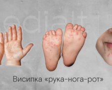 На Київщині зафіксували спалах вірусу Коксакі серед дітей