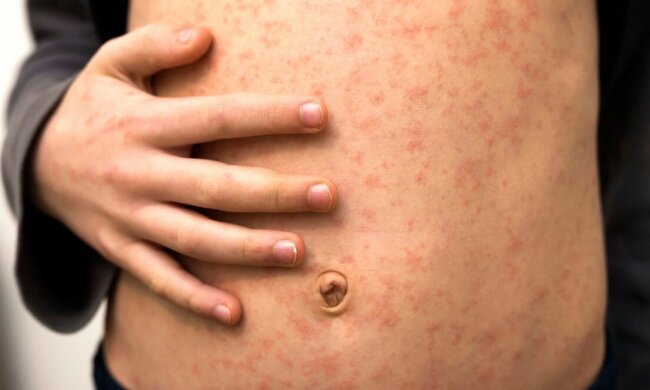 У столиці зростає захворюваність на інфекційну хворобу — кір