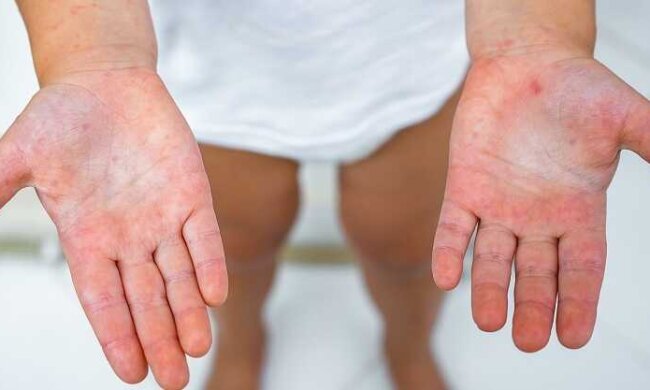 У Києві зареєстровано випадки скарлатини — скільки всього захворіло за тиждень?