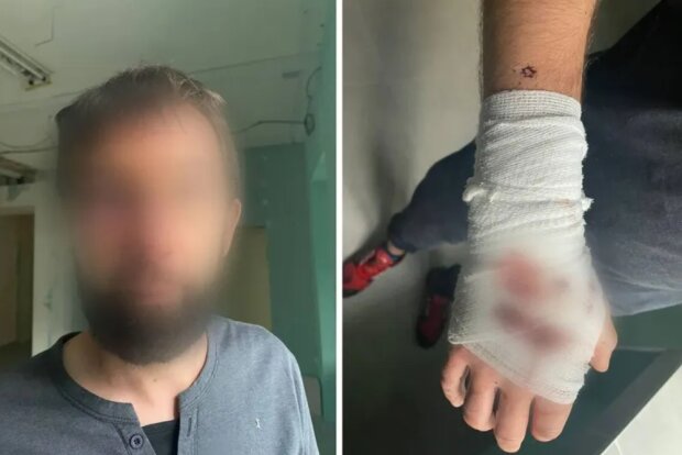 У Києві невідомі зі зброєю напали на чоловіка – 7 куль у спину і переломи