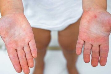 У Києві зареєстровано випадки скарлатини — скільки всього захворіло за тиждень?