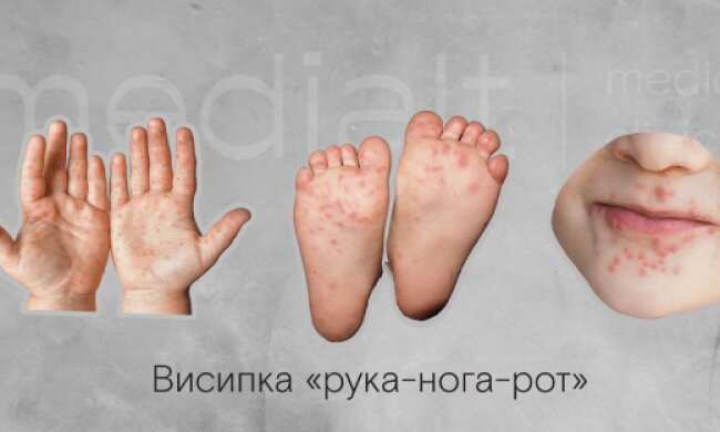 На Київщині зафіксували спалах вірусу Коксакі серед дітей